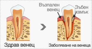 Ефект на премахване на зъбната плака (анти-плака)